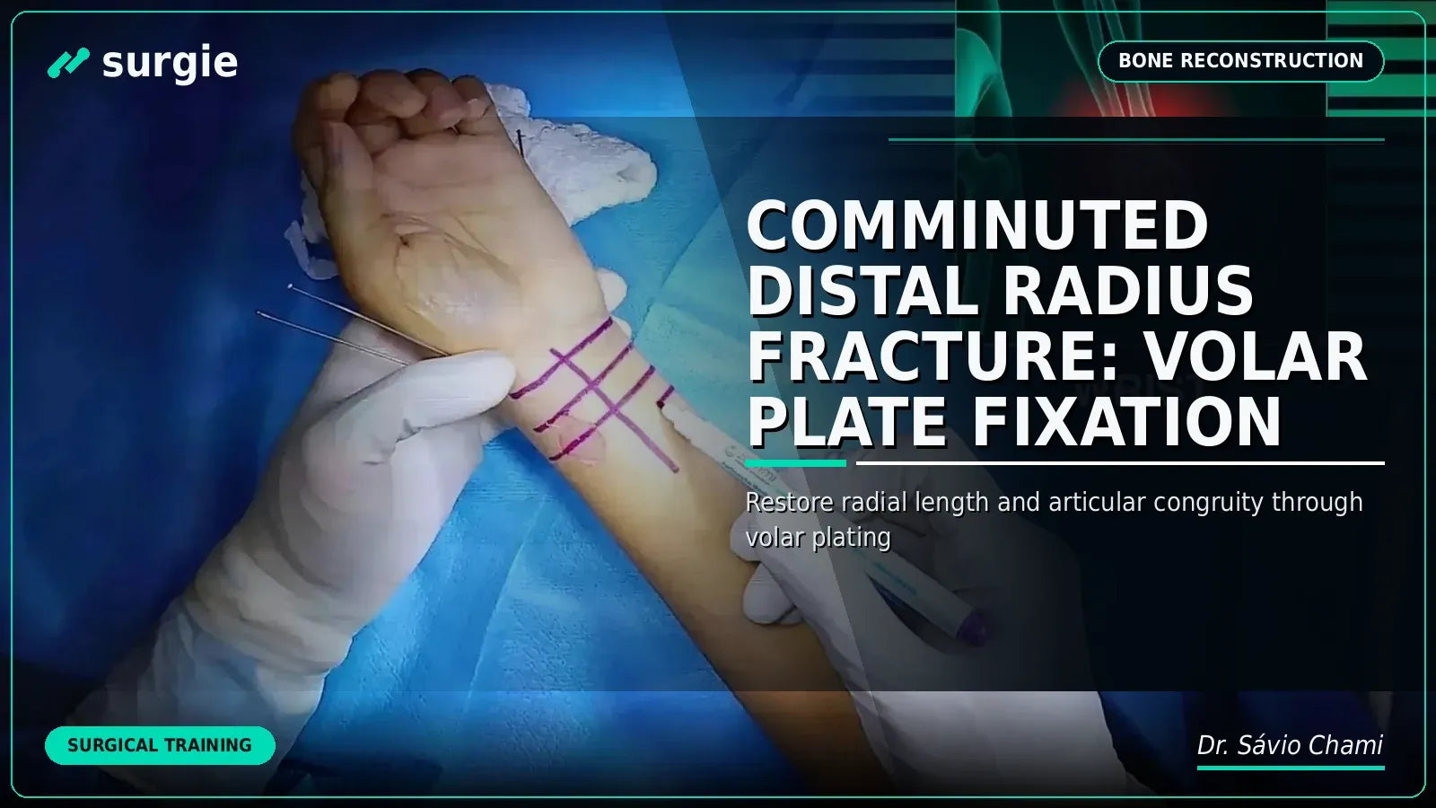 Fratura Cominutiva do Rádio Distal: Fixação com Placa Volar