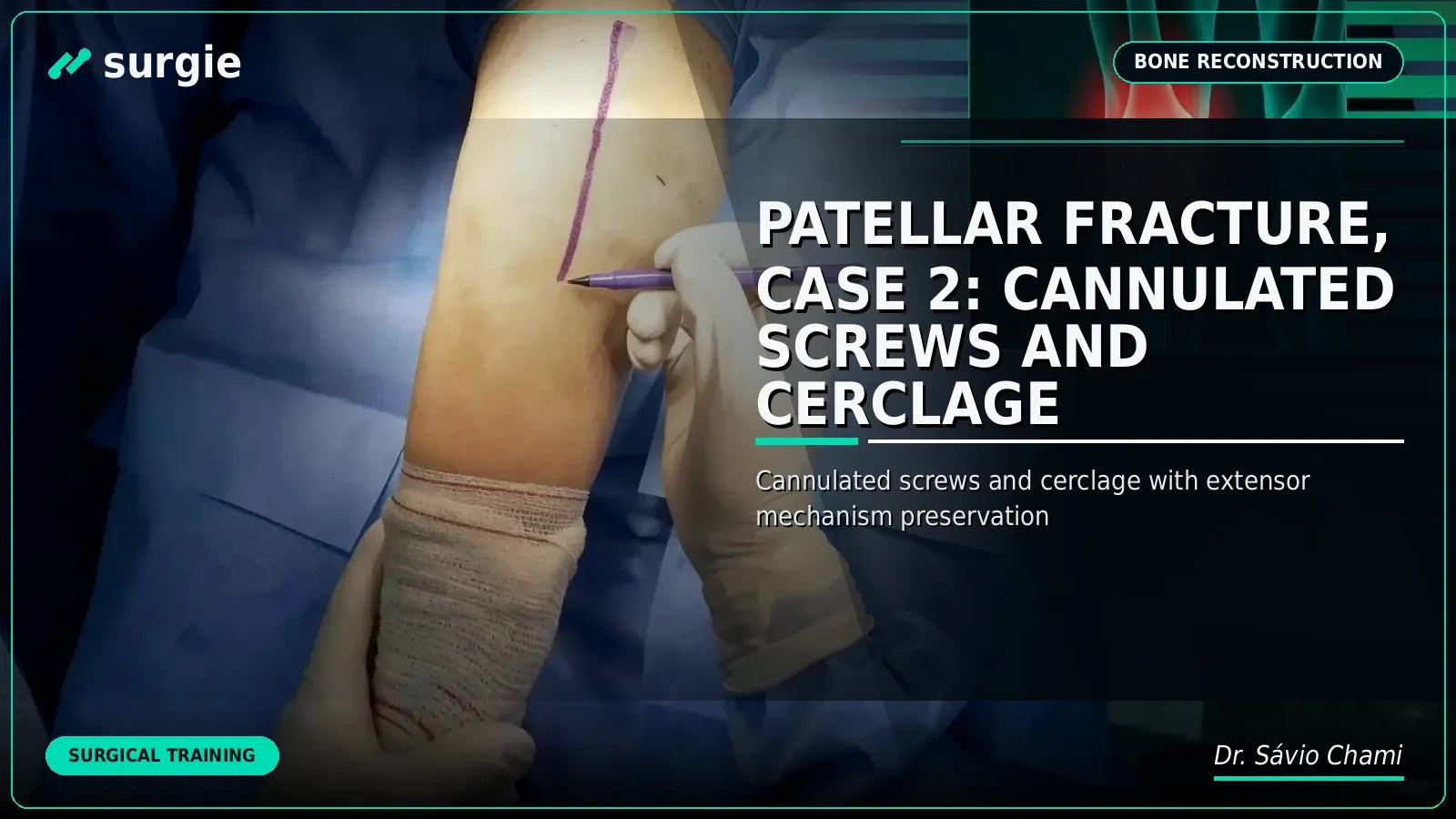 Patellar Fracture, Case 2: Cannulated Screws and Cerclage