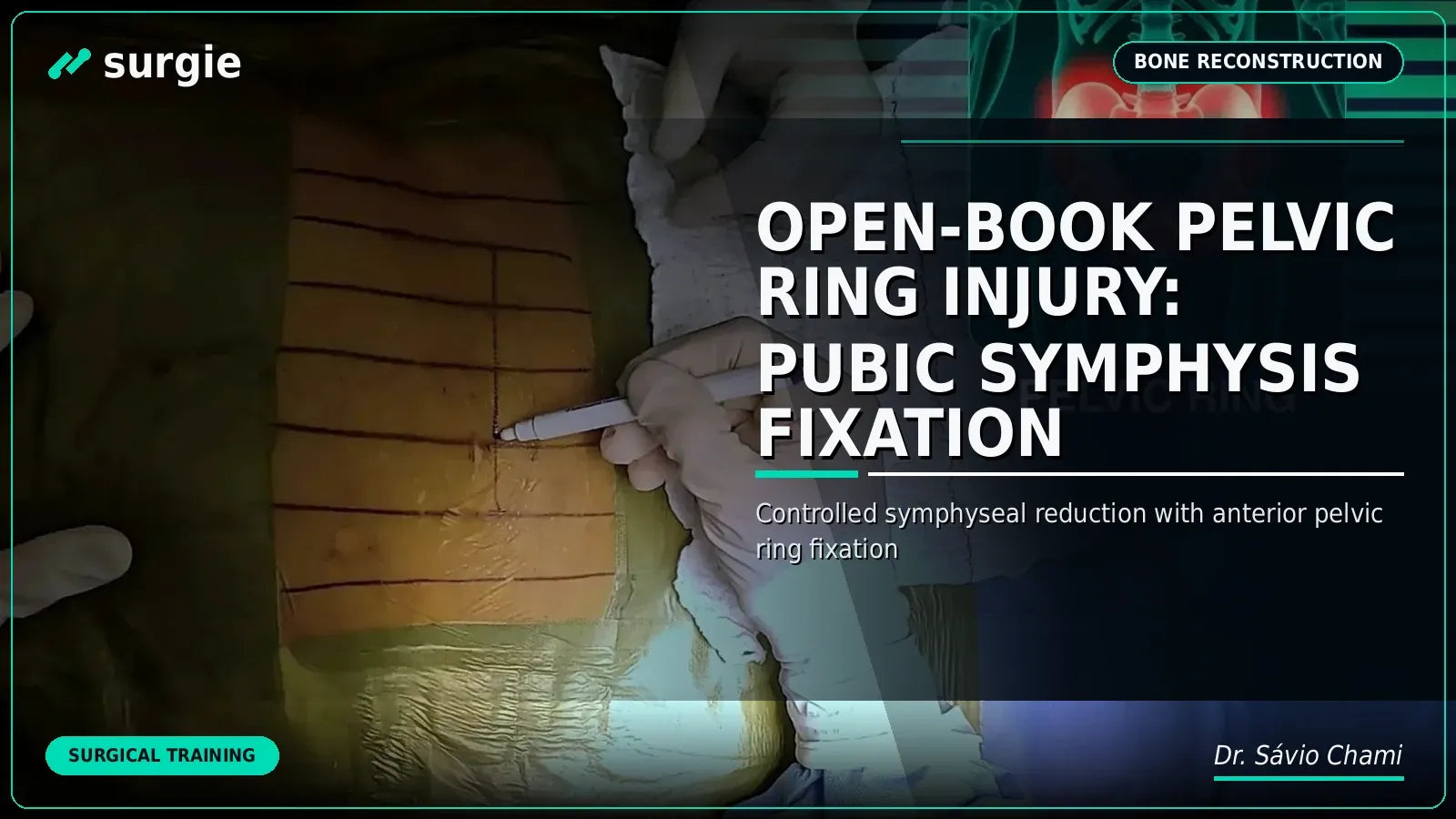 Open-Book Pelvic Ring Injury: Pubic Symphysis Fixation