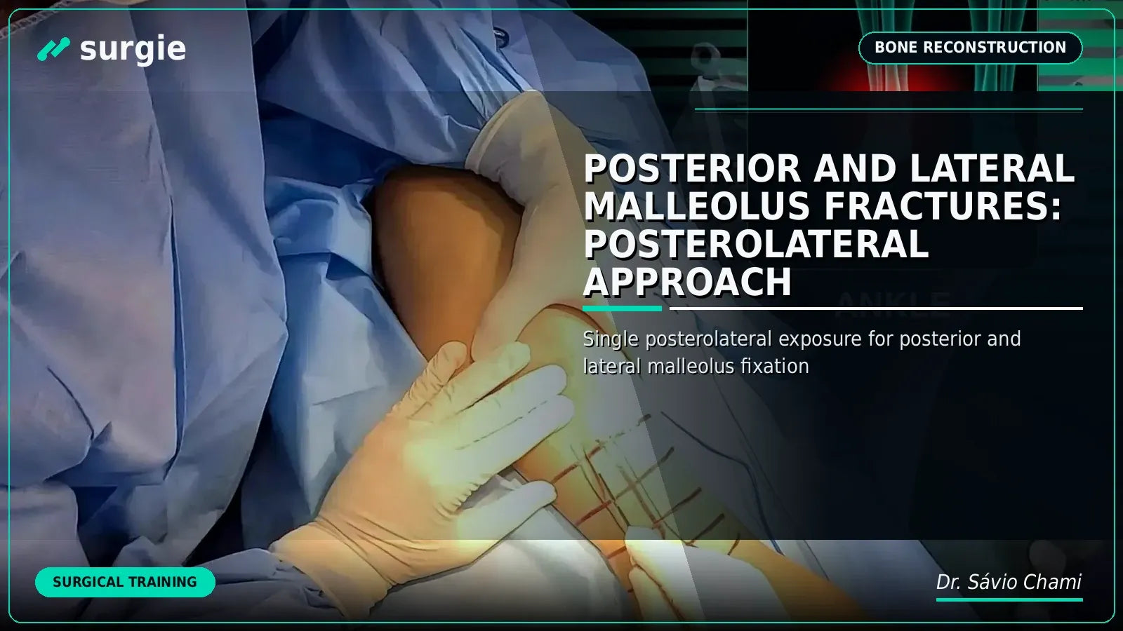 Posterior and Lateral Malleolus Fractures: Posterolateral Approach