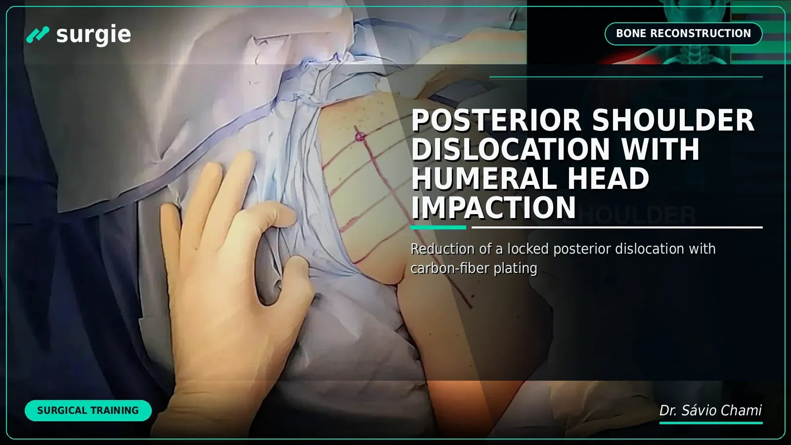 Posterior Shoulder Dislocation with Humeral Head Impaction