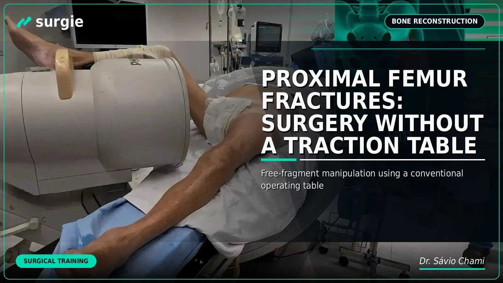 Proximal Femur Fractures: Surgery without a Traction Table