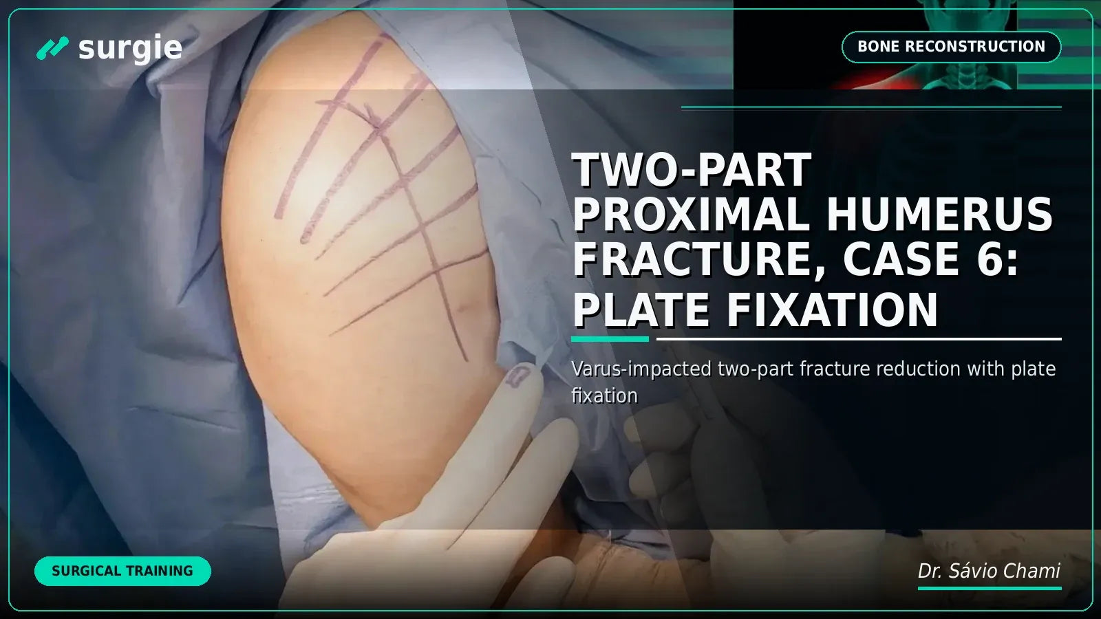 Two-Part Proximal Humerus Fracture, Case 6: Plate Fixation