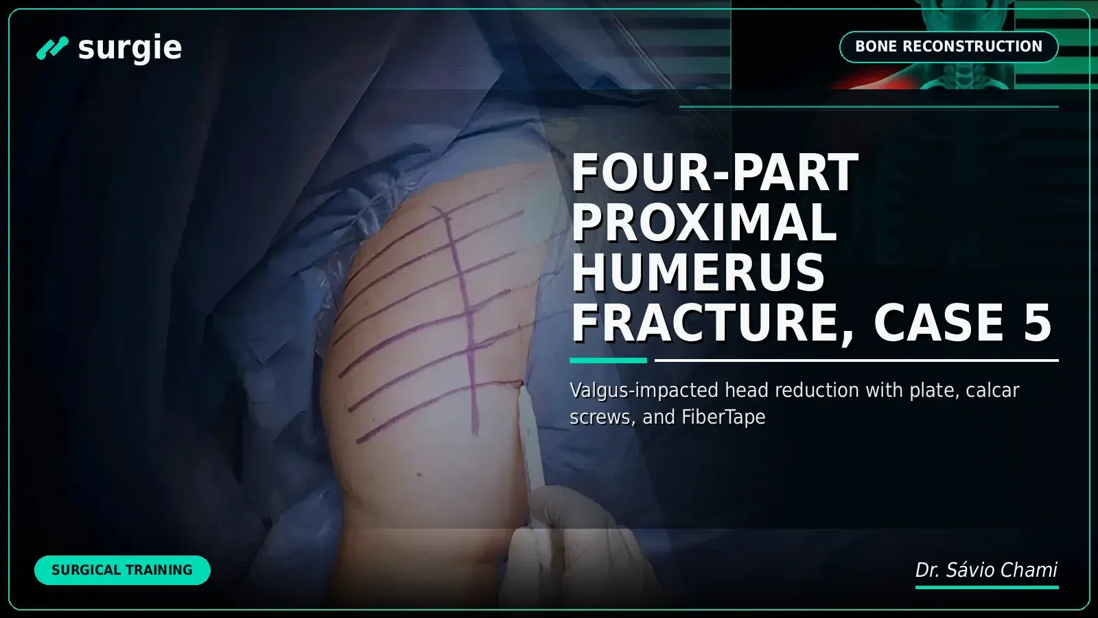 Four-Part Proximal Humerus Fracture, Case 5