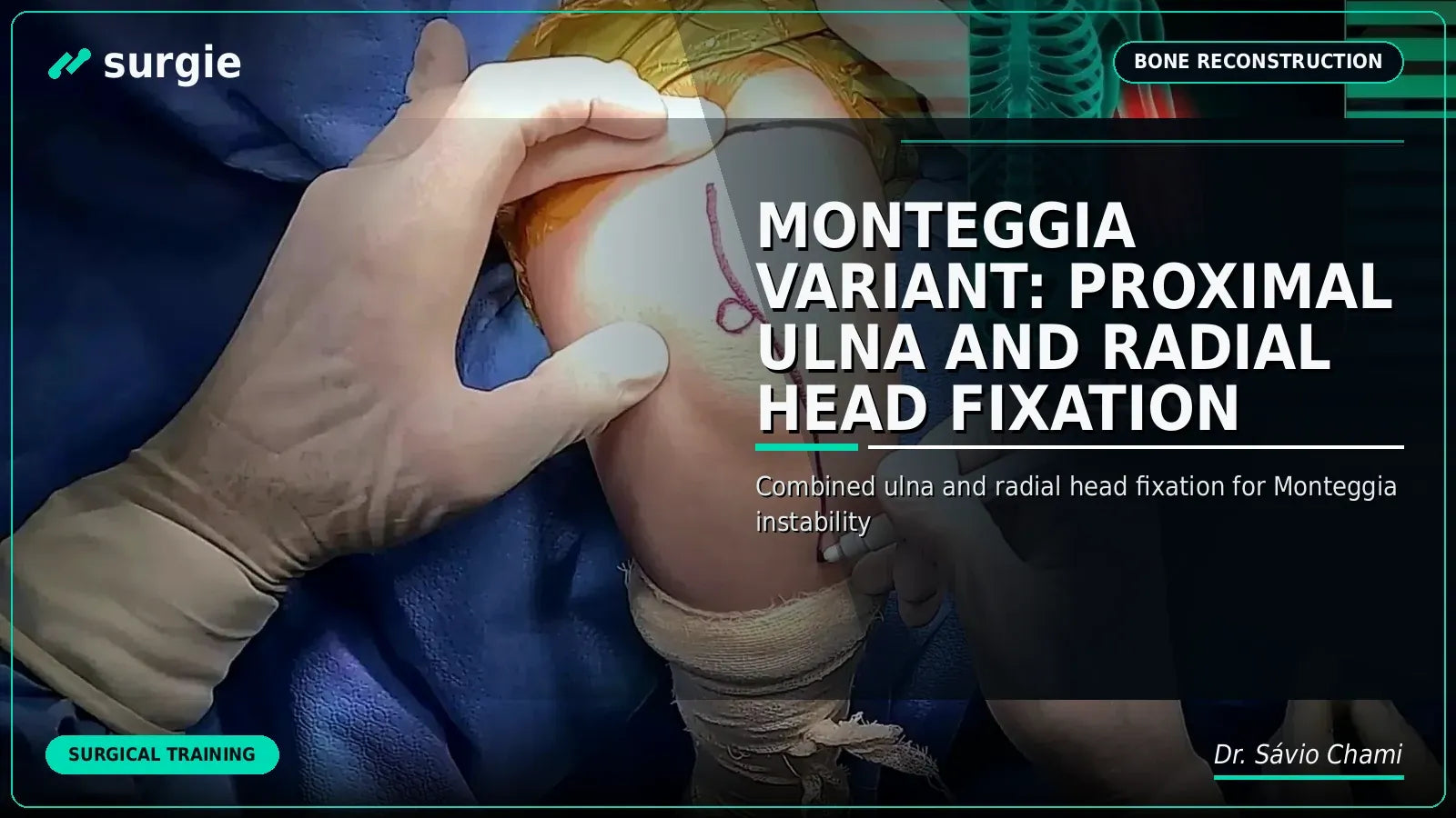 Monteggia Variant: Proximal Ulna and Radial Head Fixation