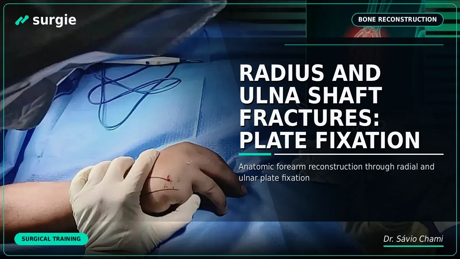 Fraturas do Rádio e Ulna: Fixação com Placa