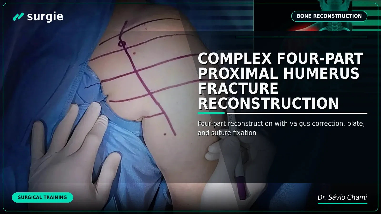 Complex Four-Part Proximal Humerus Fracture Reconstruction