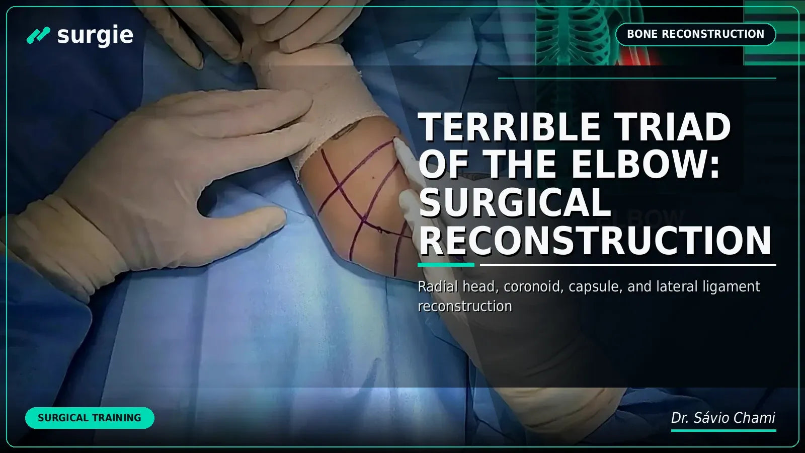 Terrible Triad of the Elbow: Surgical Reconstruction