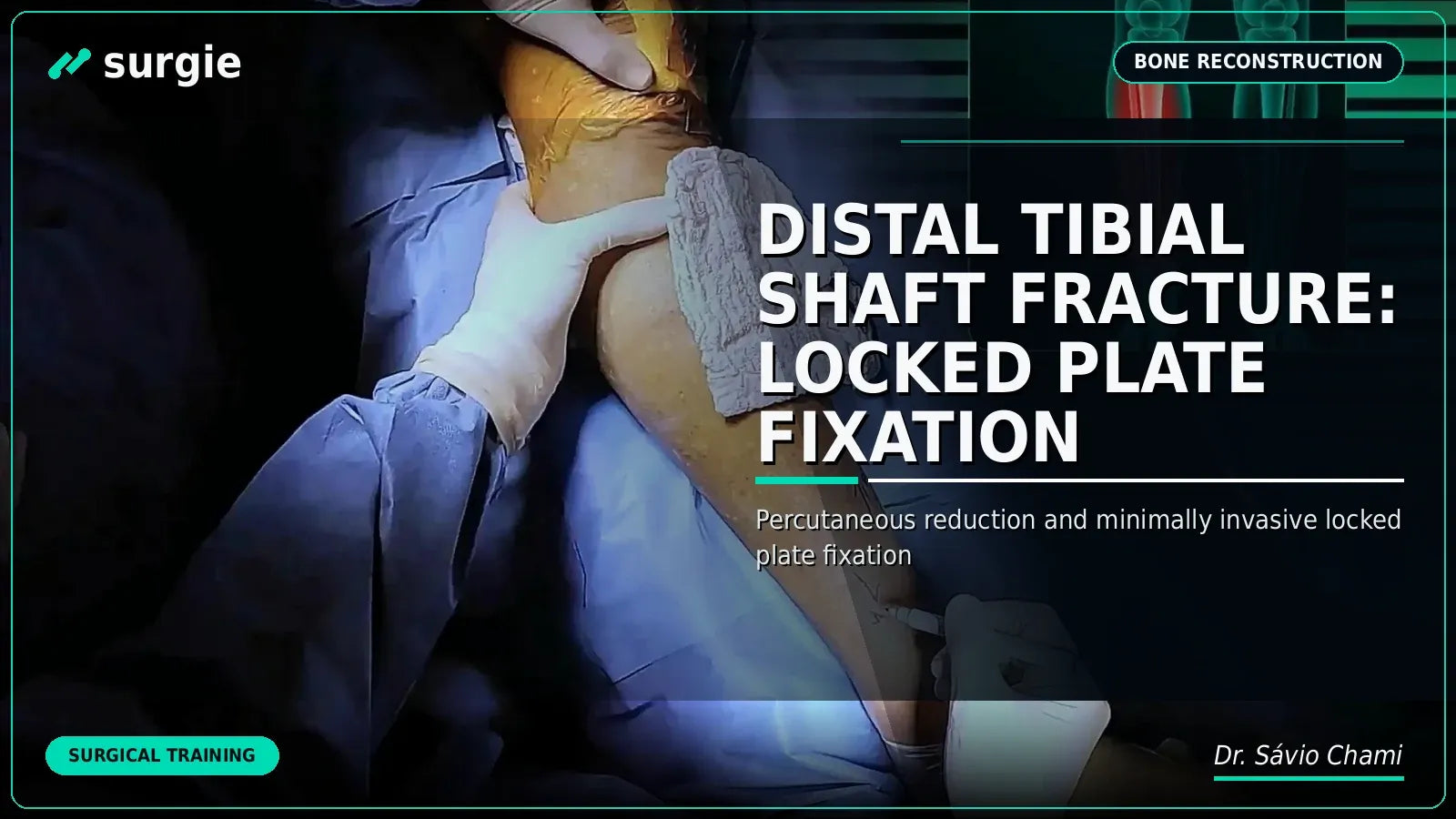Distal Tibial Shaft Fracture: Locked Plate Fixation