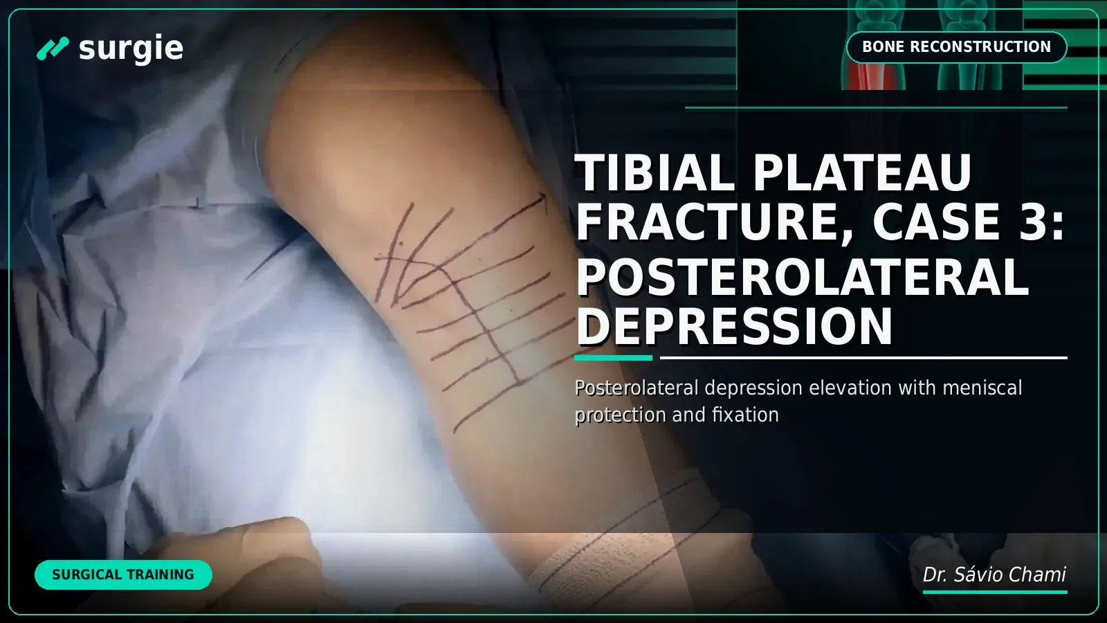 Tibial Plateau Fracture, Case 3: Posterolateral Depression