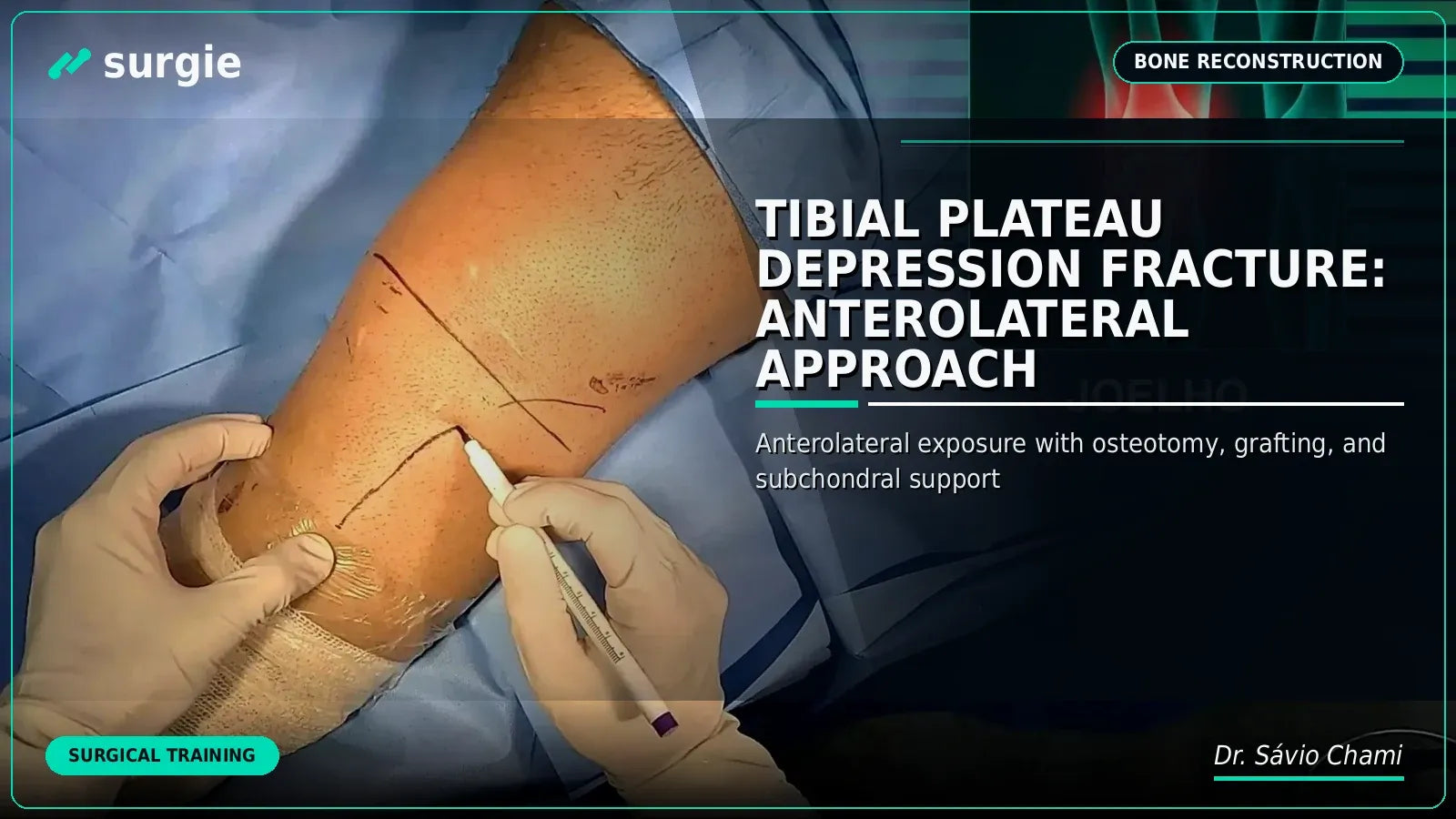 Tibial Plateau Depression Fracture: Anterolateral Approach