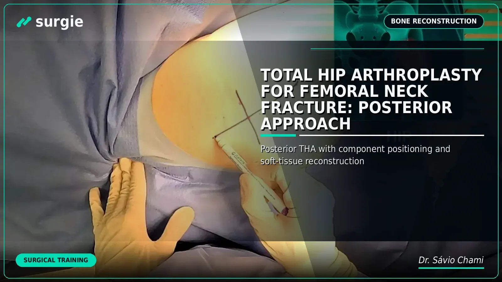 Total Hip Arthroplasty for Femoral Neck Fracture: Posterior Approach