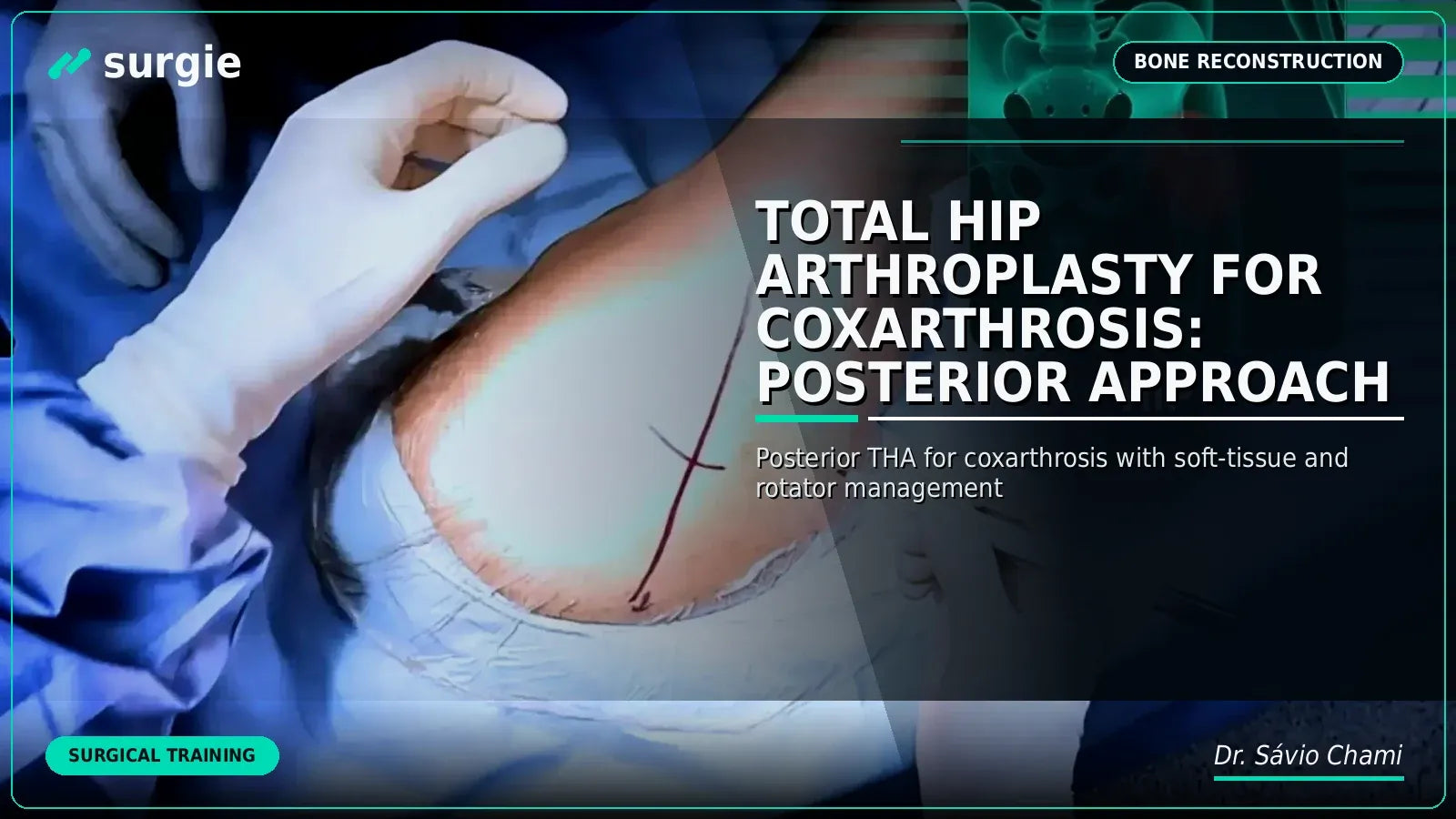 Total Hip Arthroplasty for Coxarthrosis: Posterior Approach