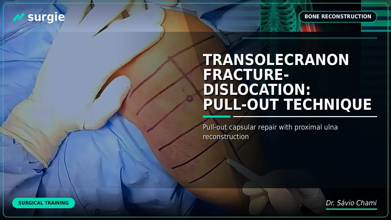 Transolecranon Fracture-Dislocation: Pull-Out Technique