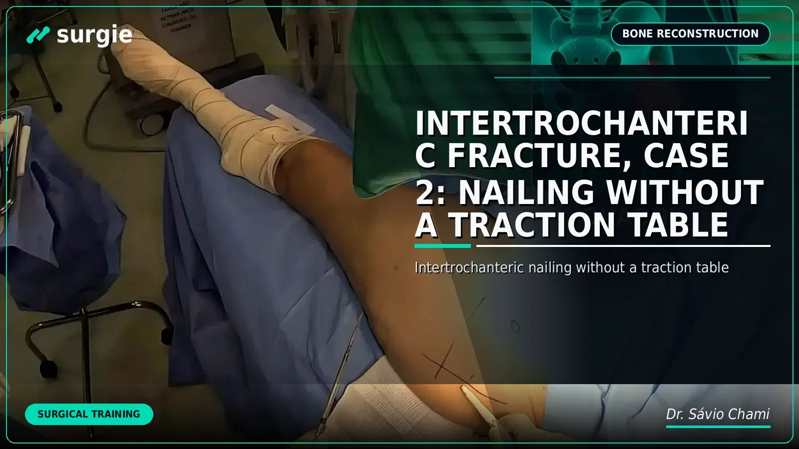Intertrochanteric Fracture, Case 2: Nailing without a Traction Table