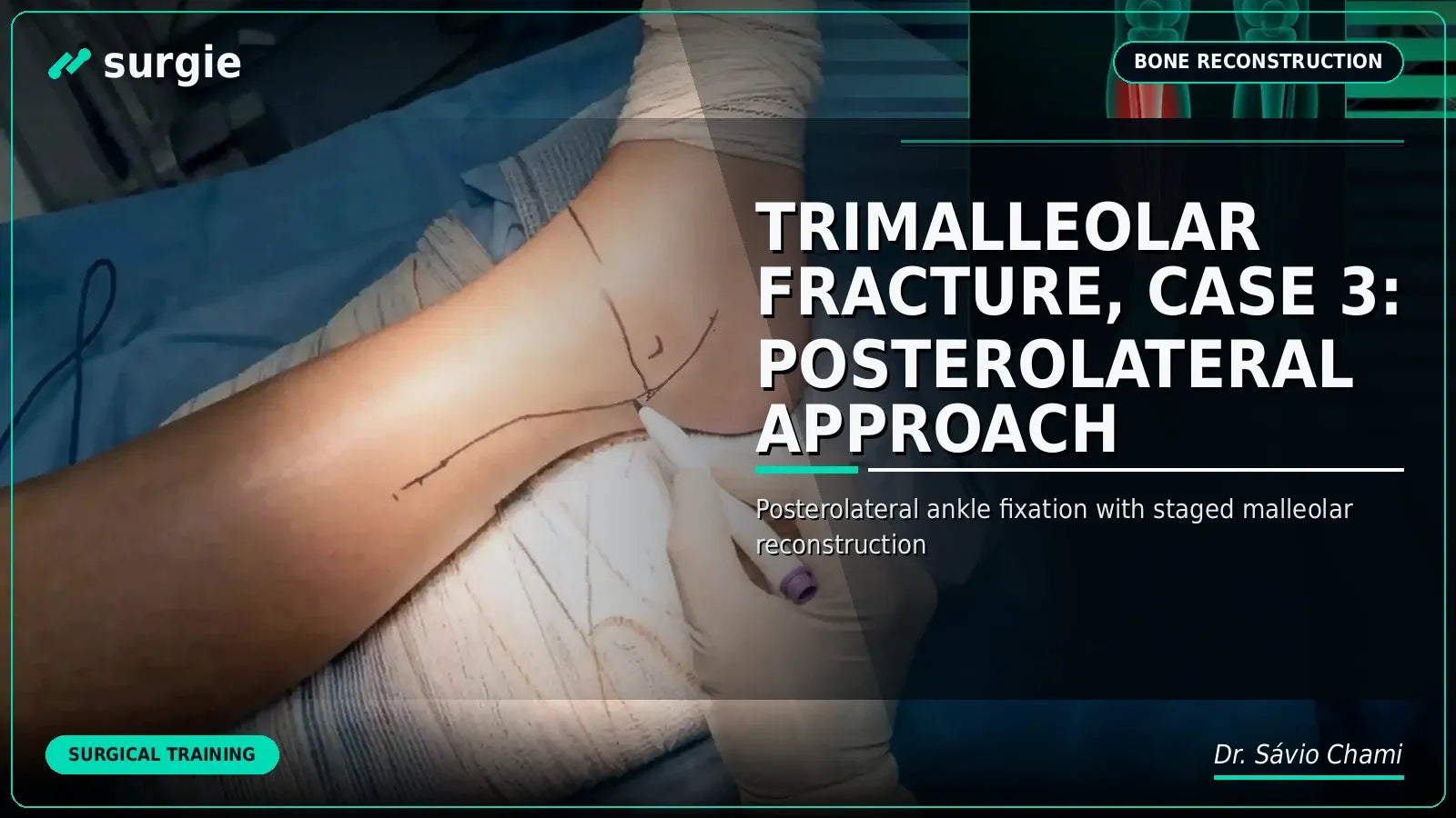Trimalleolar Fracture, Case 3: Posterolateral Approach