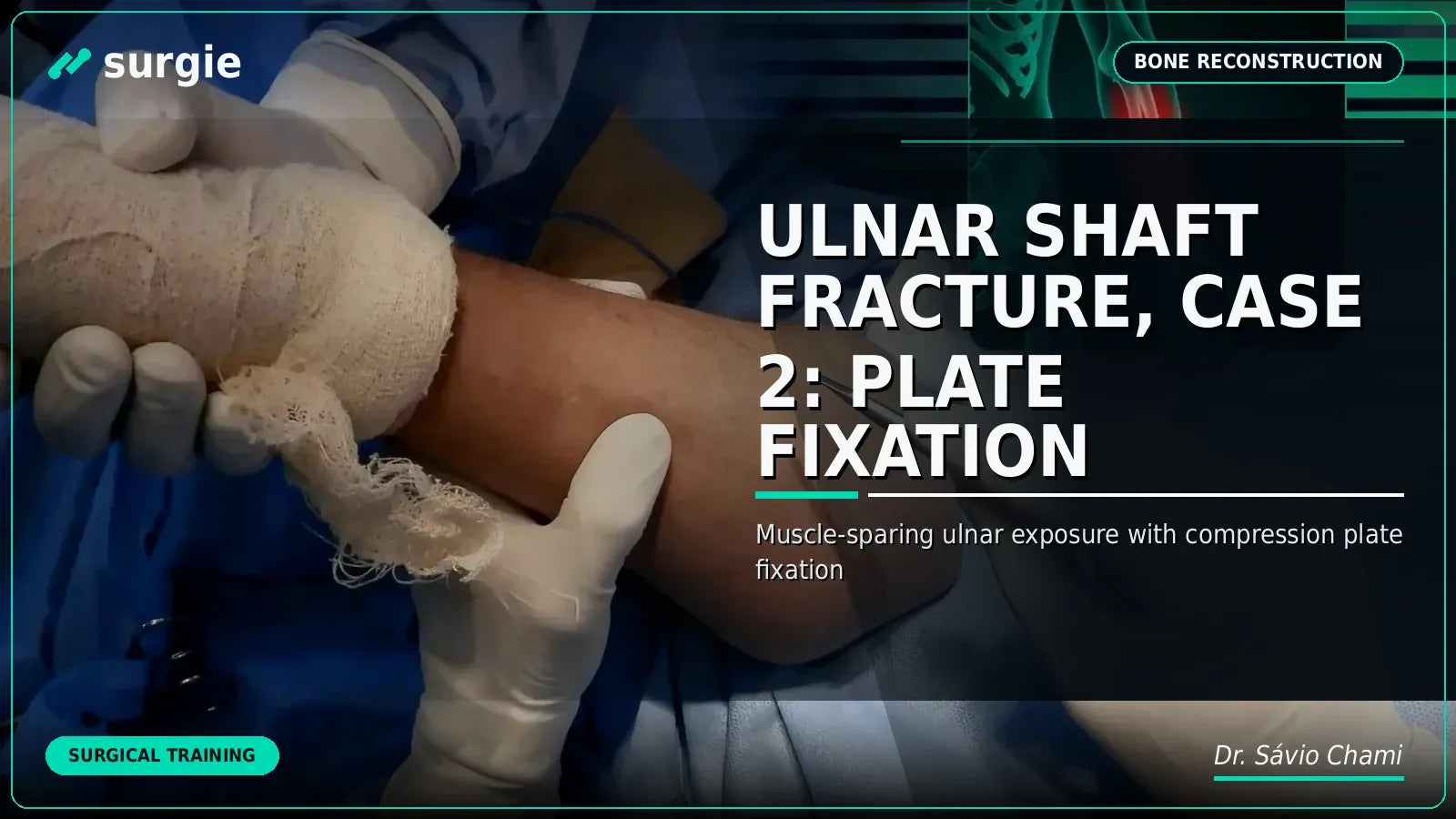 Ulnar Shaft Fracture, Case 2: Plate Fixation