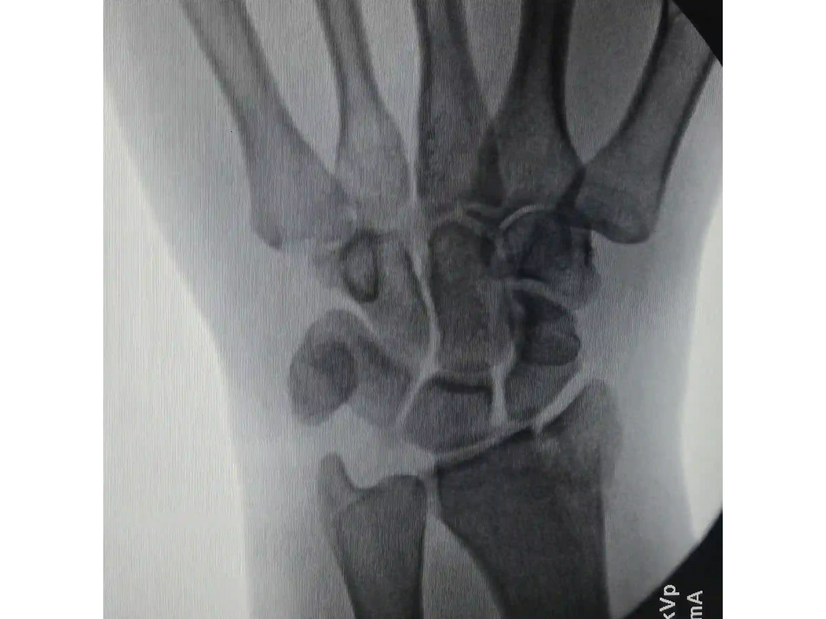 DISTAL RADIUS [CASE 03] - Volar Barton