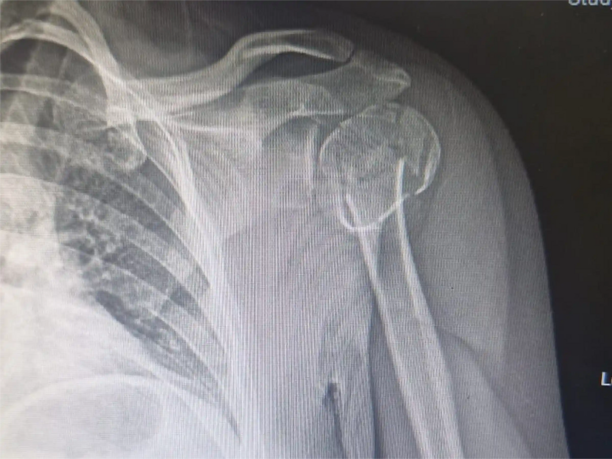 Proximal Humerus [Case 07] - Head-Split in a Young Patient with Plate and Screws