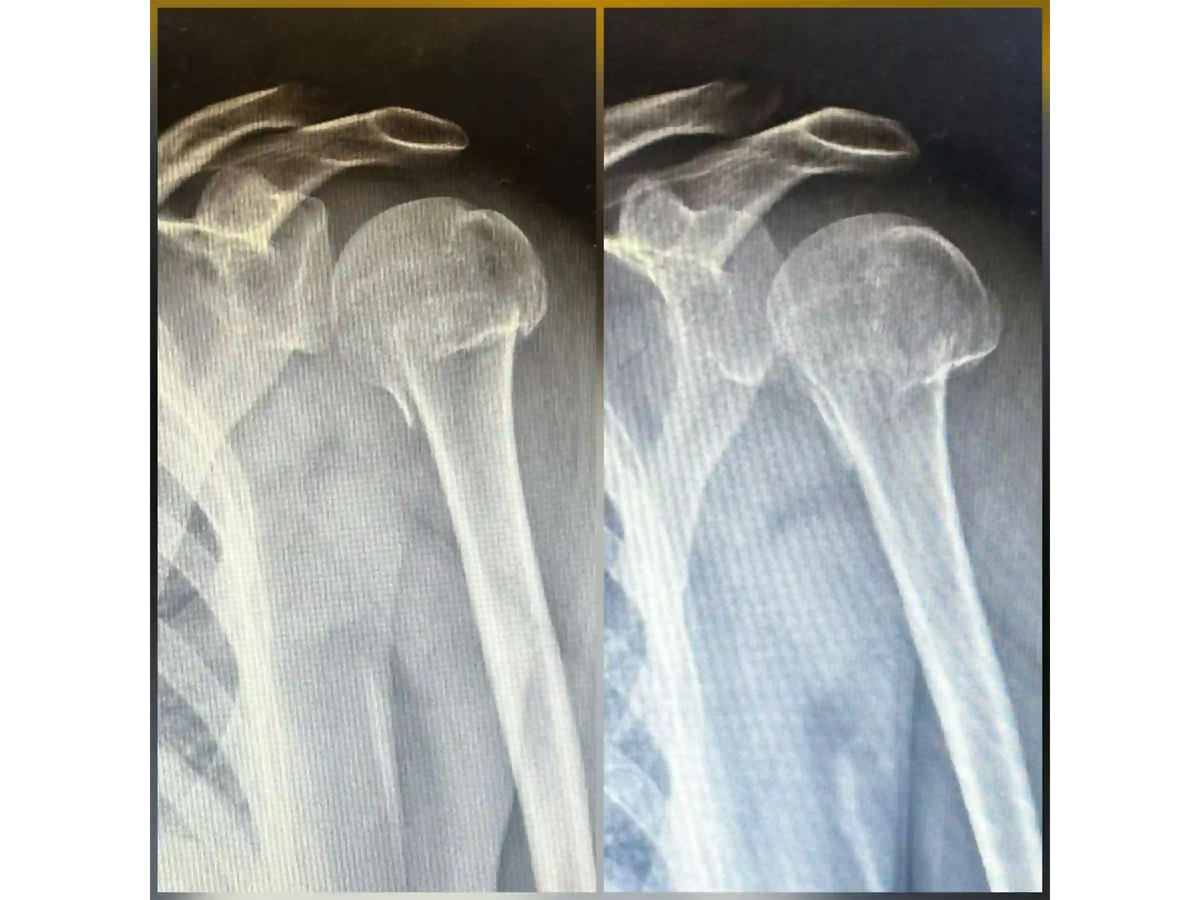 PROXIMAL HUMERUS [CASE 04] - Intramedullary Nail
