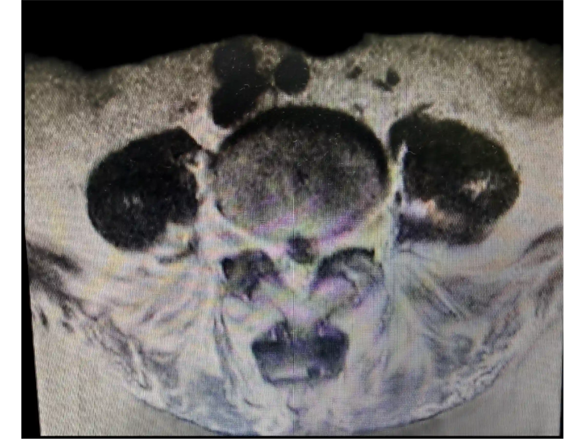 Endoscopic Lumbar Discectomy for Left L4-L5 Disc Herniation