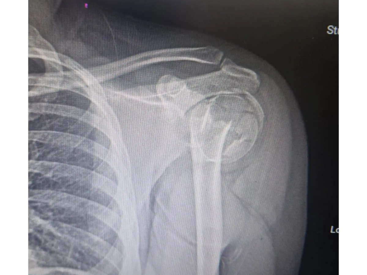Proximal Humerus [Case 07] - Head-Split in a Young Patient with Plate and Screws