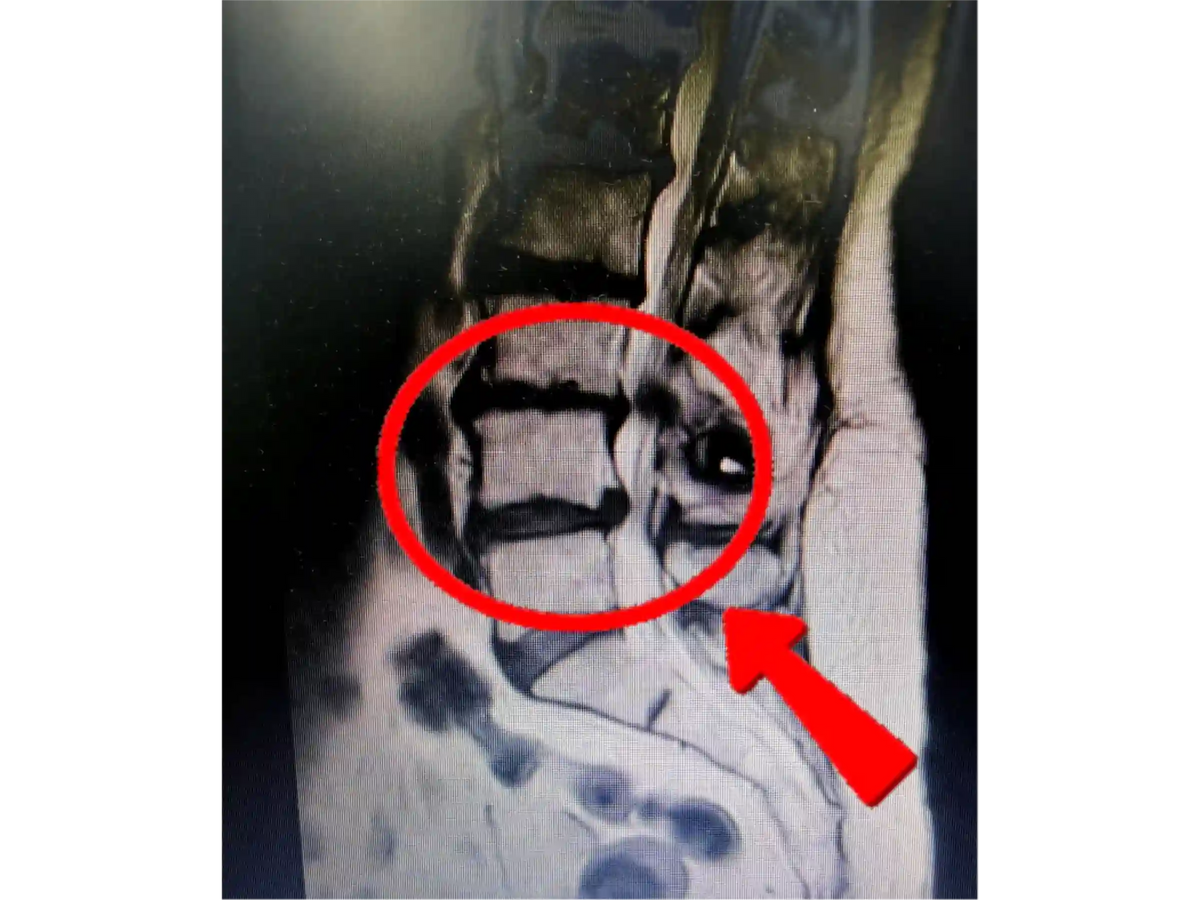Endoscopic Lumbar Discectomy for Left L4-L5 Disc Herniation