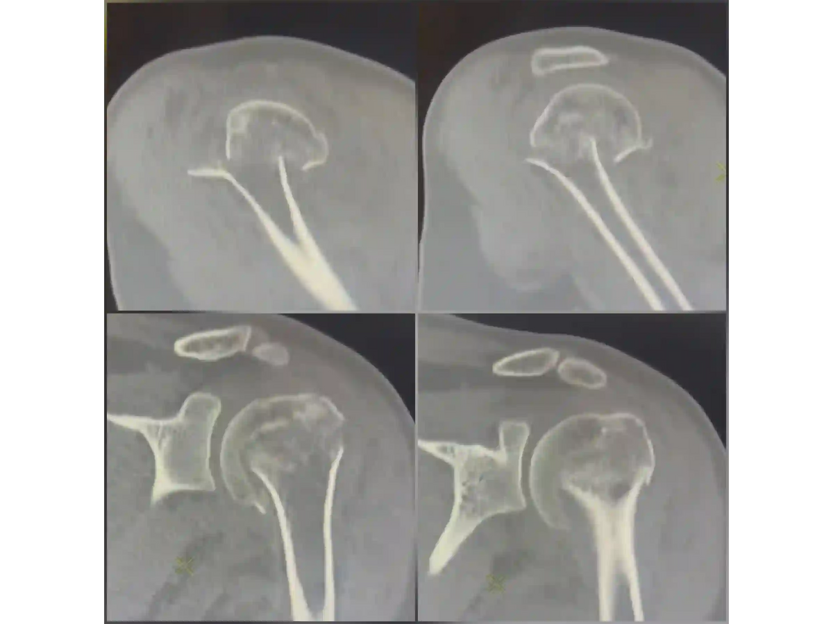 PROXIMAL HUMERUS [CASE 04] - Intramedullary Nail