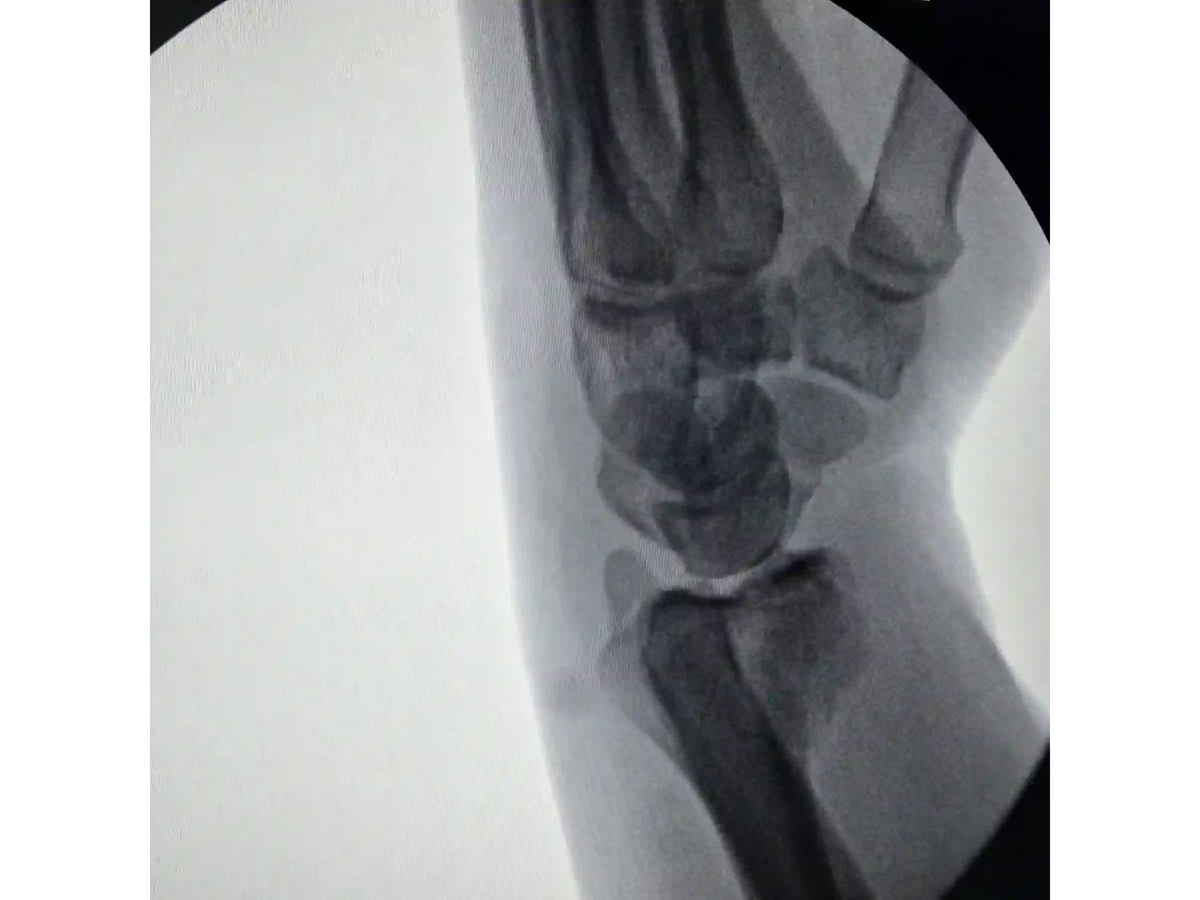 DISTAL RADIUS [CASE 03] - Volar Barton