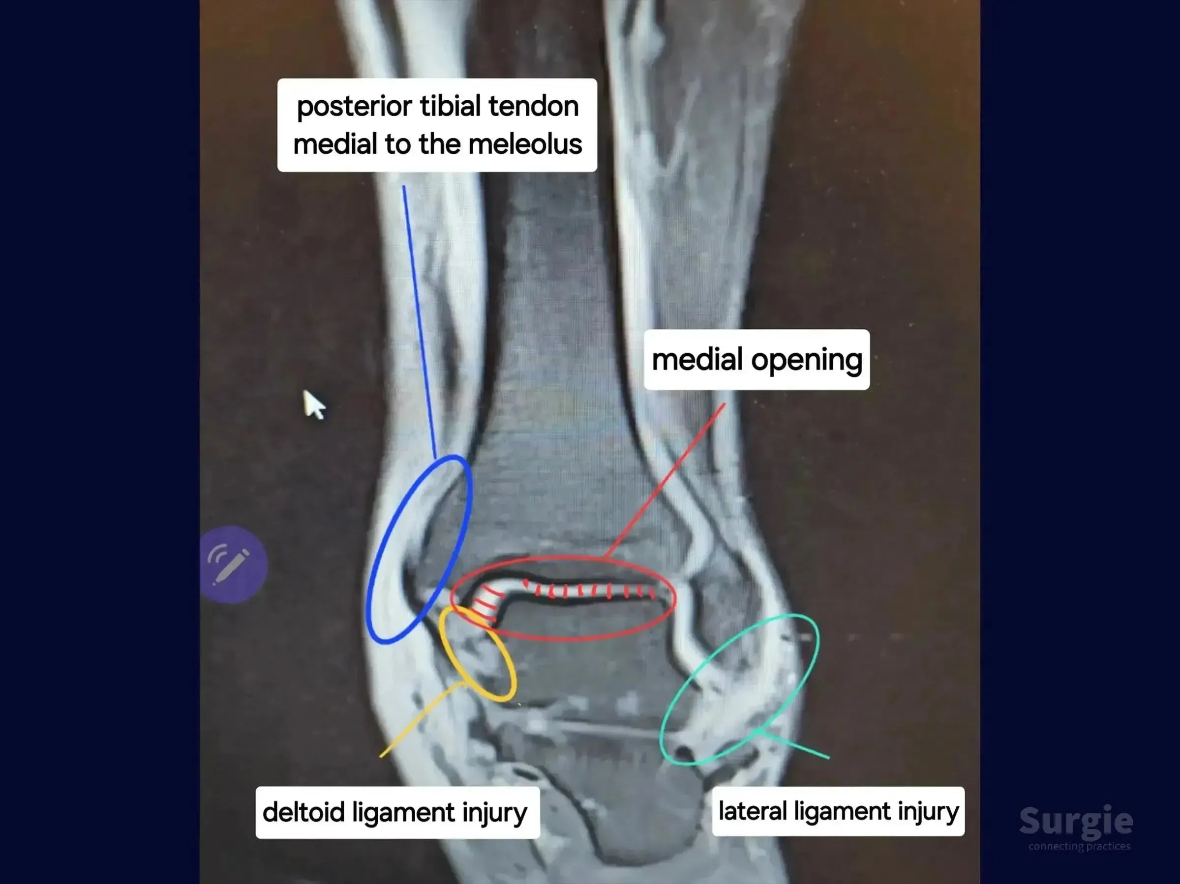 Ankle MRI scan with color-coded annotations highlighting posterior tibial tendon dislocation and ligamentous injuries.