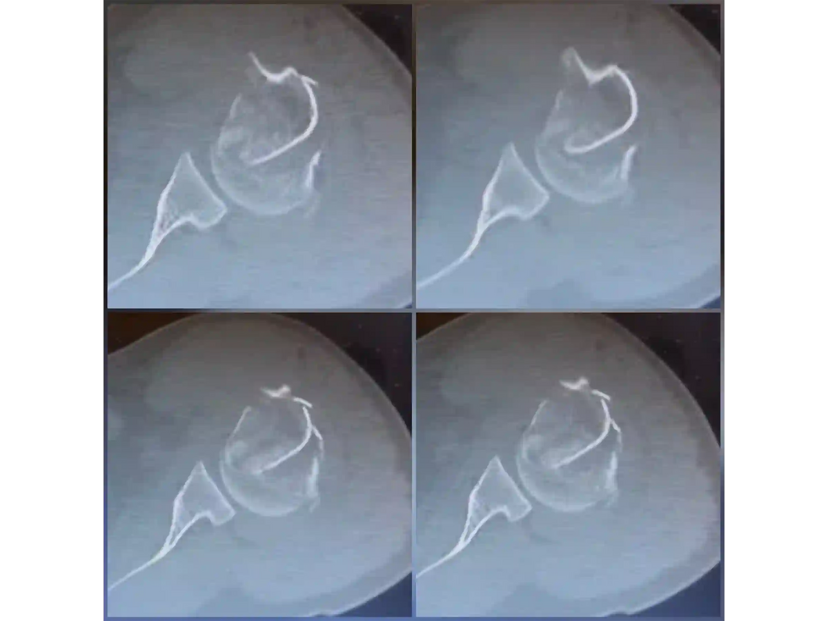 PROXIMAL HUMERUS [CASE 04] - Intramedullary Nail