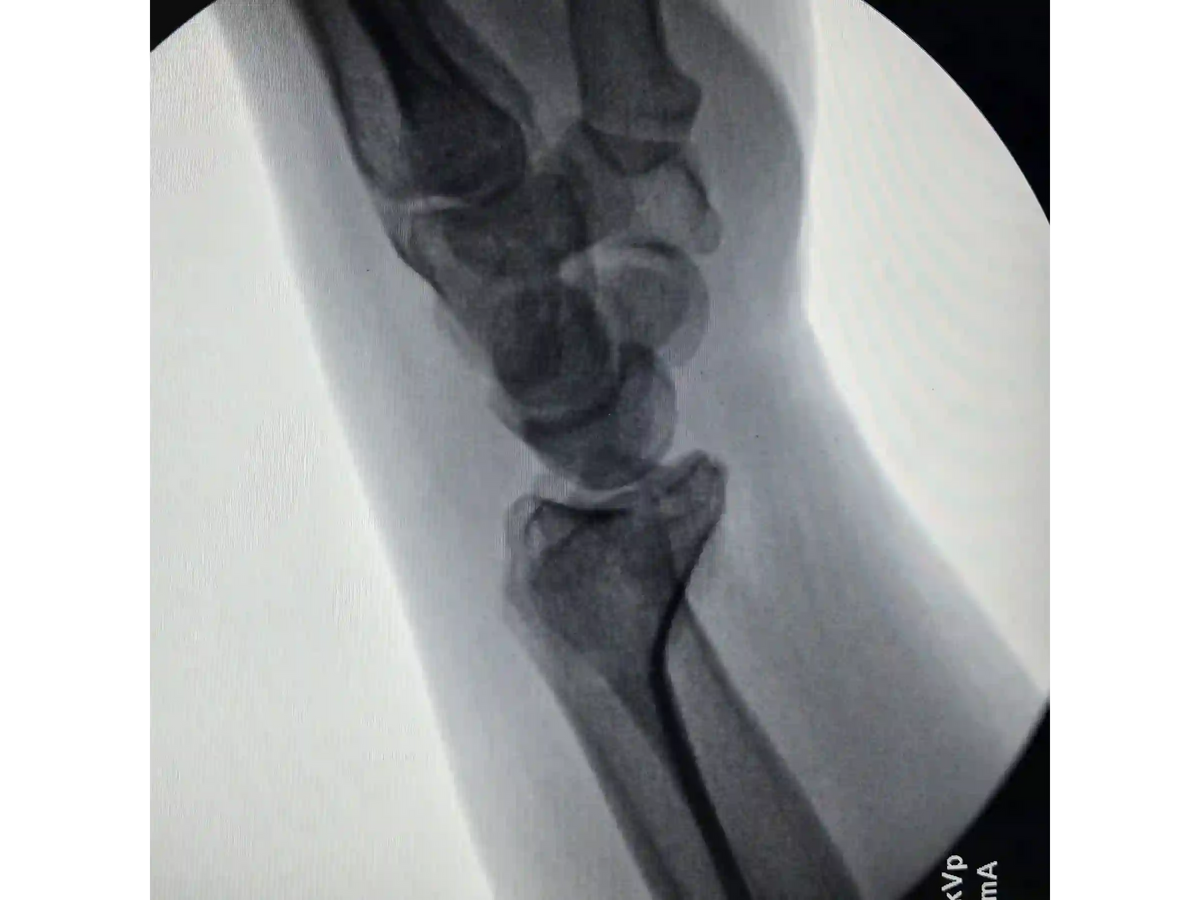DISTAL RADIUS [CASE 03] - Volar Barton
