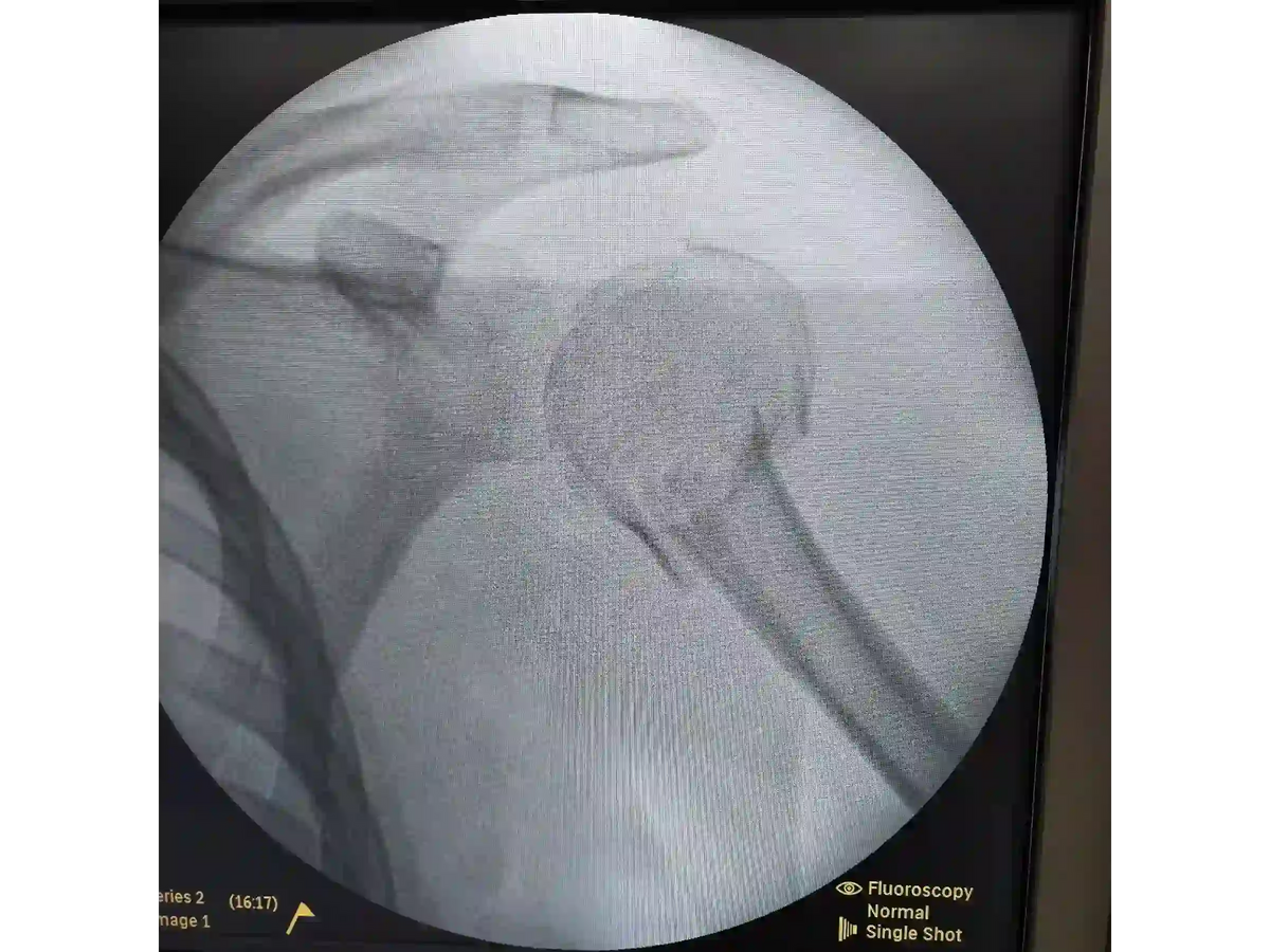 Proximal Humerus [Case 07] - Head-Split in a Young Patient with Plate and Screws