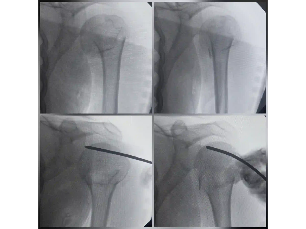 PROXIMAL HUMERUS [CASE 04] - Intramedullary Nail
