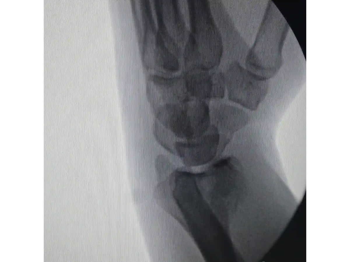 DISTAL RADIUS [CASE 03] - Volar Barton