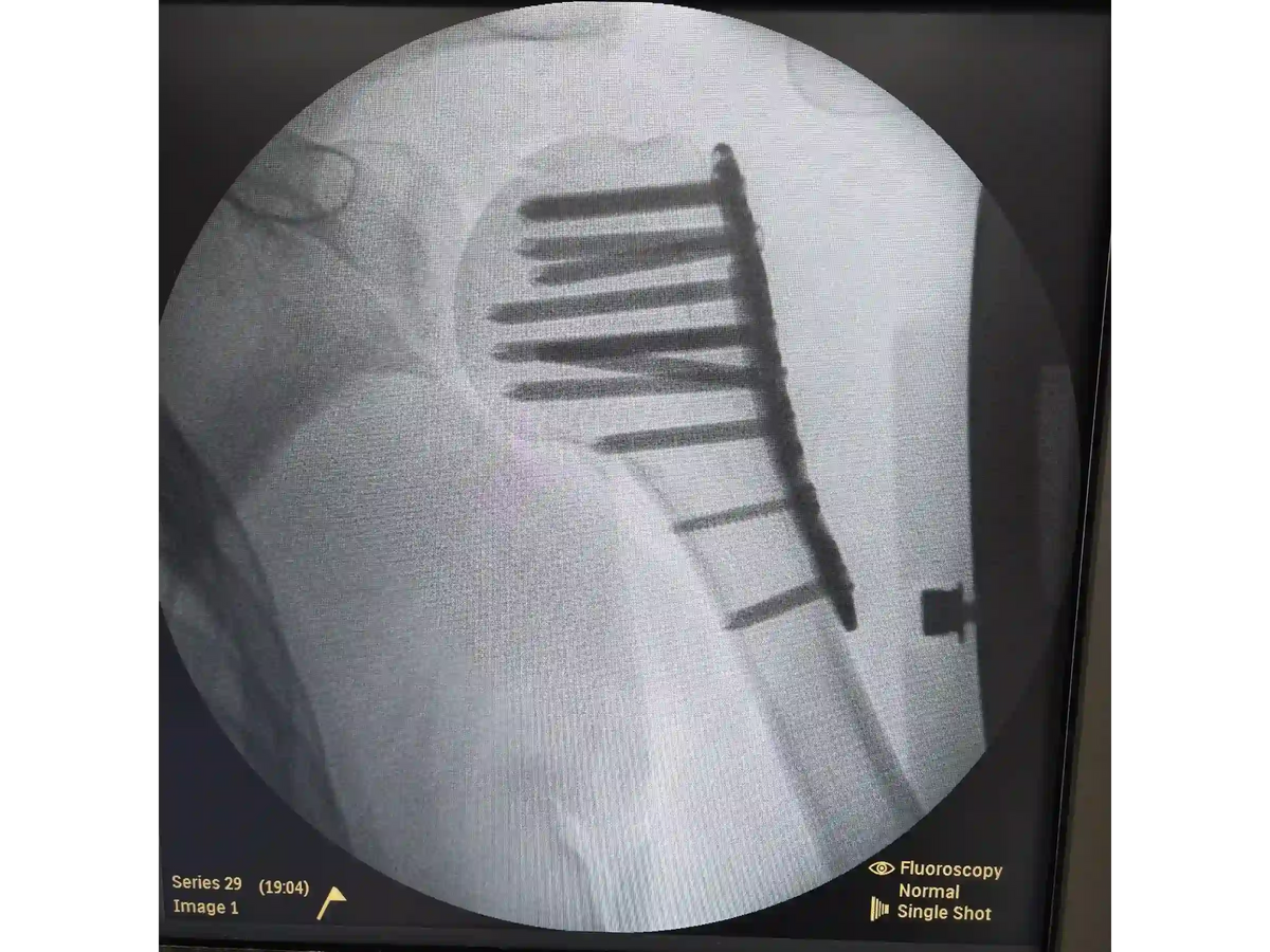 Proximal Humerus [Case 07] - Head-Split in a Young Patient with Plate and Screws