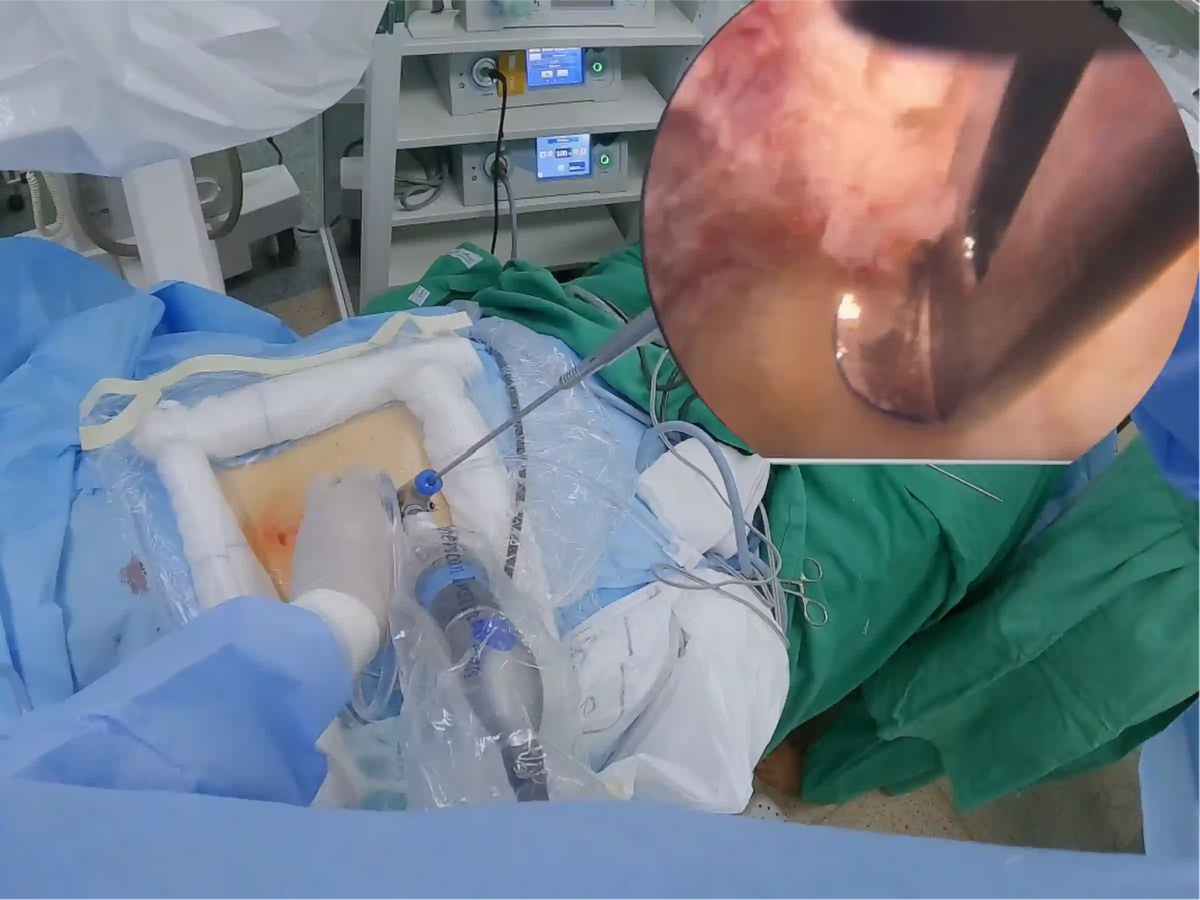 Endoscopic Lumbar Discectomy for Left L4-L5 Disc Herniation
