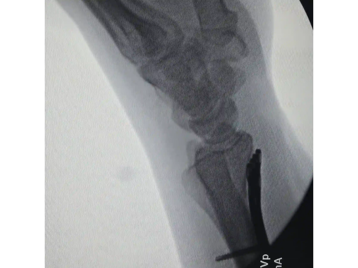DISTAL RADIUS [CASE 03] - Volar Barton