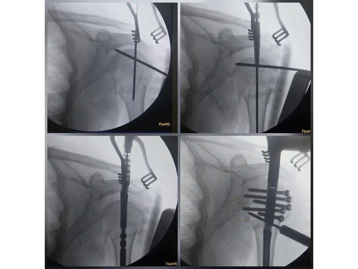 PROXIMAL HUMERUS [CASE 04] - Intramedullary Nail
