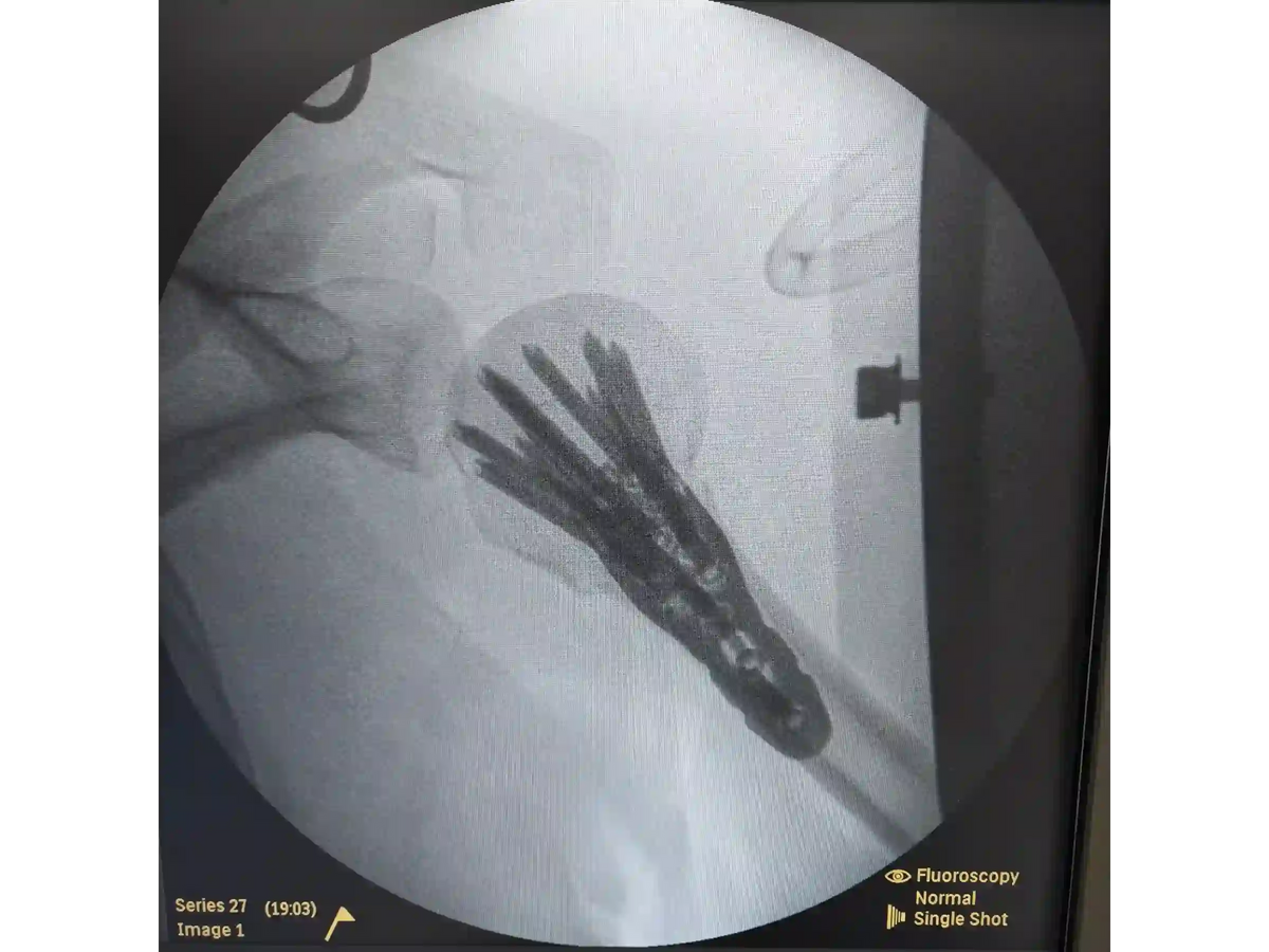 Proximal Humerus [Case 07] - Head-Split in a Young Patient with Plate and Screws
