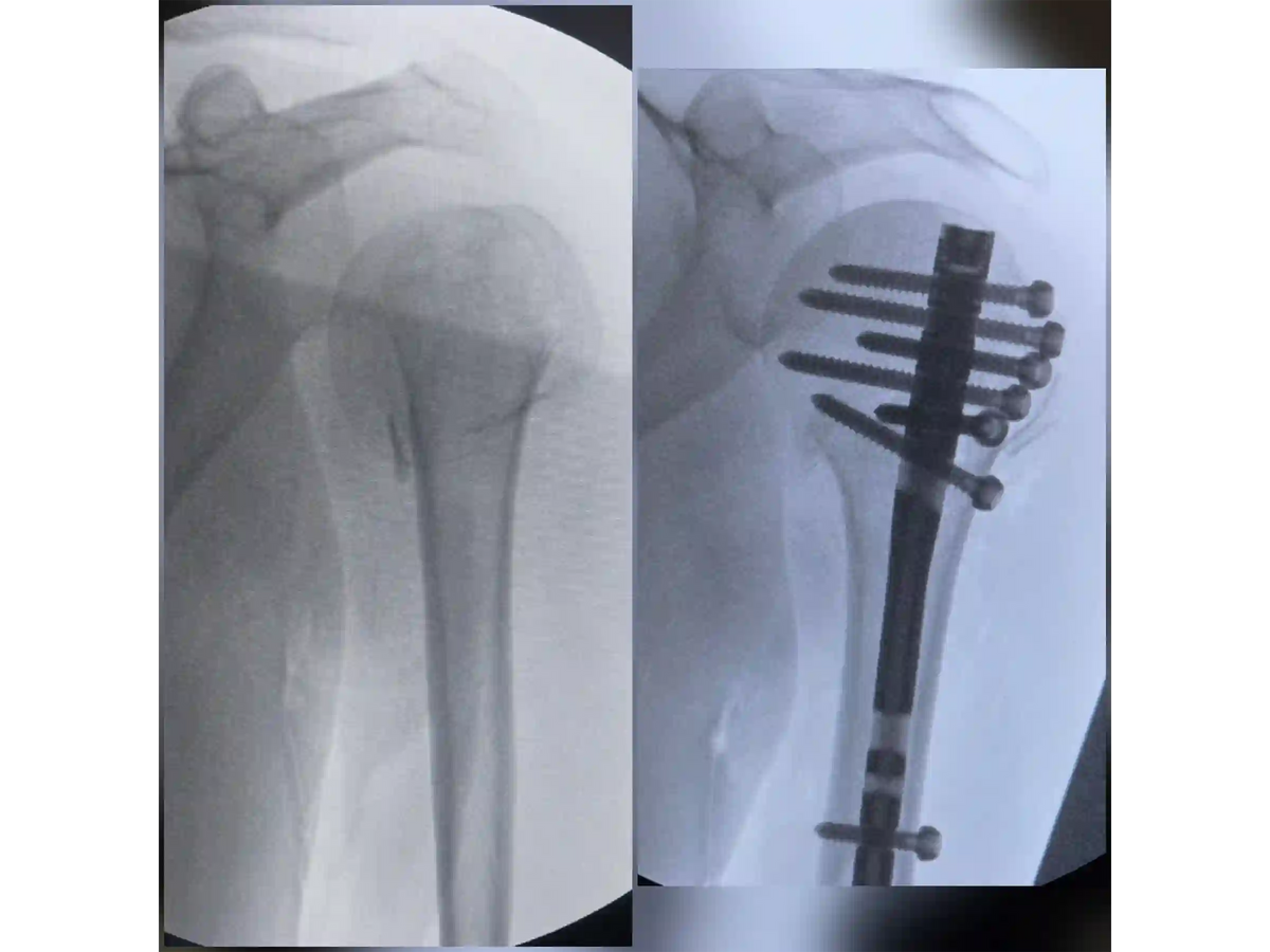 PROXIMAL HUMERUS [CASE 04] - Intramedullary Nail