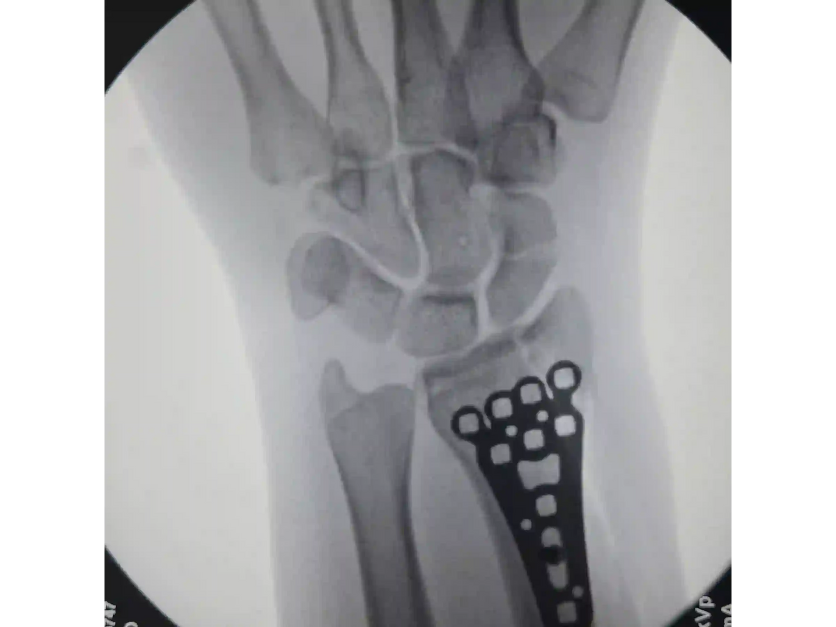 DISTAL RADIUS [CASE 03] - Volar Barton