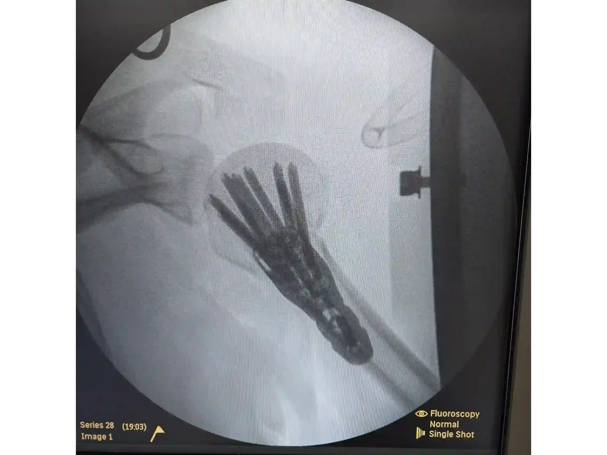 Proximal Humerus [Case 07] - Head-Split in a Young Patient with Plate and Screws
