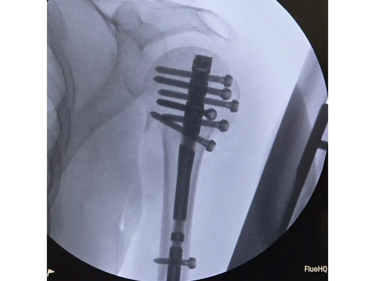PROXIMAL HUMERUS [CASE 04] - Intramedullary Nail