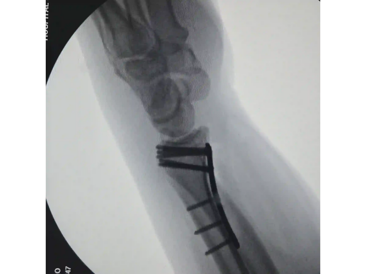 DISTAL RADIUS [CASE 03] - Volar Barton