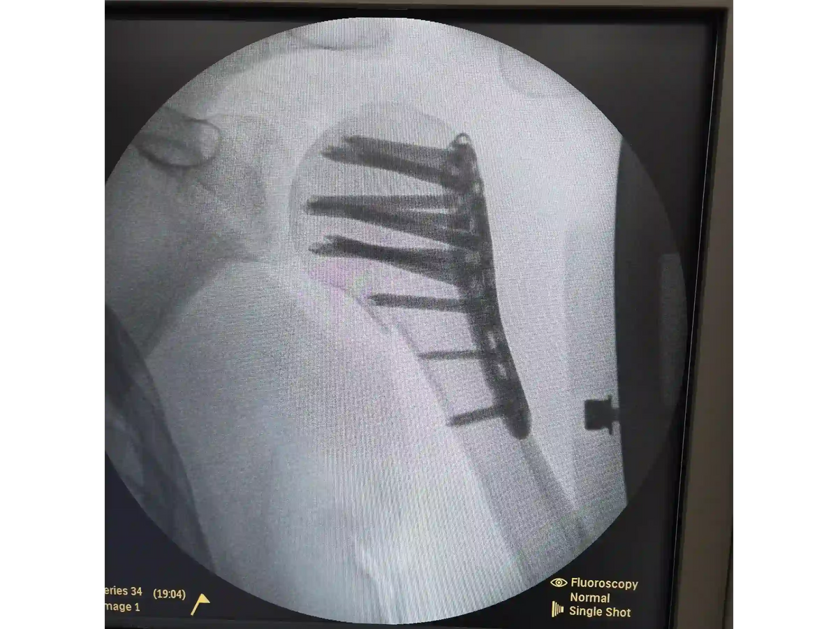 Proximal Humerus [Case 07] - Head-Split in a Young Patient with Plate and Screws