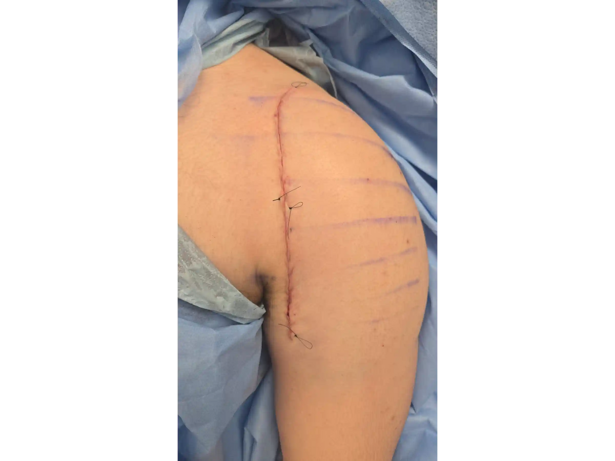 Proximal Humerus [Case 07] - Head-Split in a Young Patient with Plate and Screws