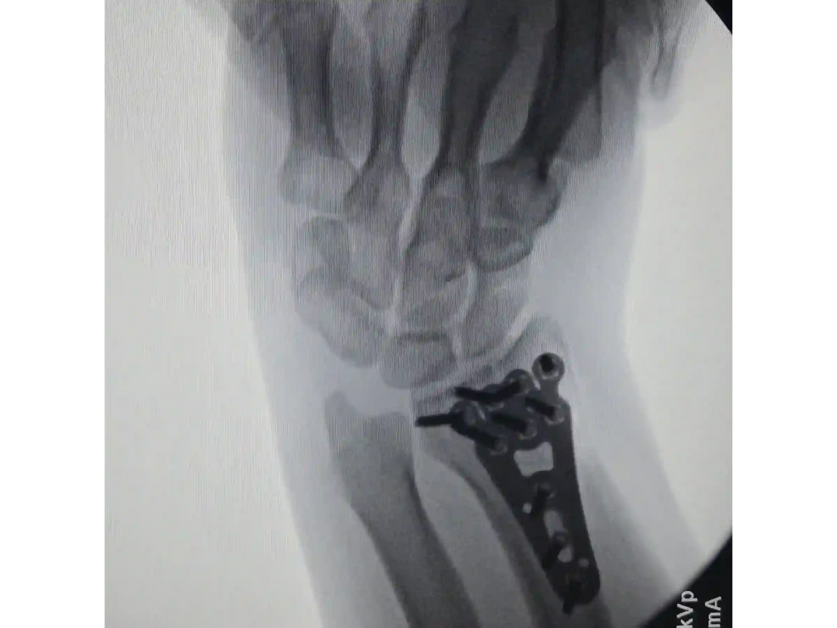 DISTAL RADIUS [CASE 03] - Volar Barton