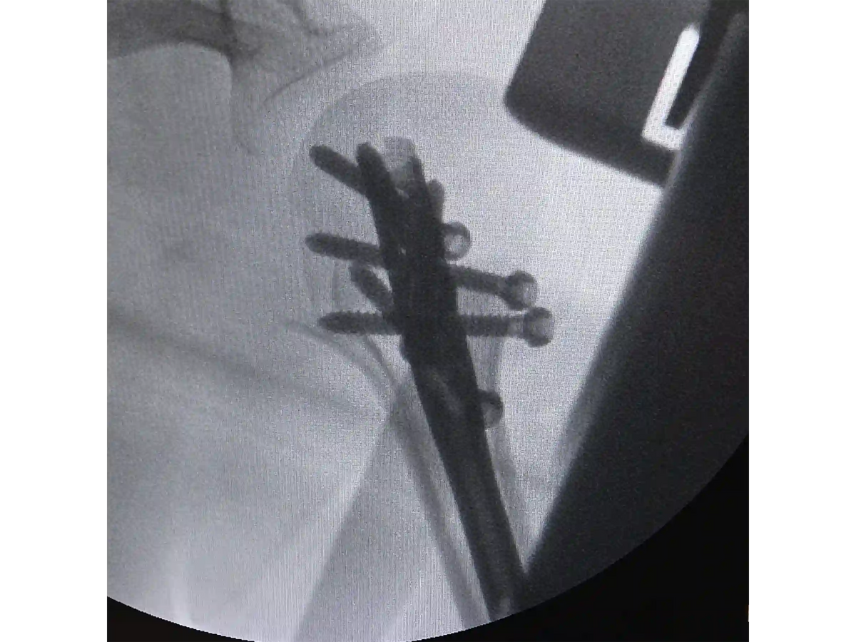 PROXIMAL HUMERUS [CASE 04] - Intramedullary Nail