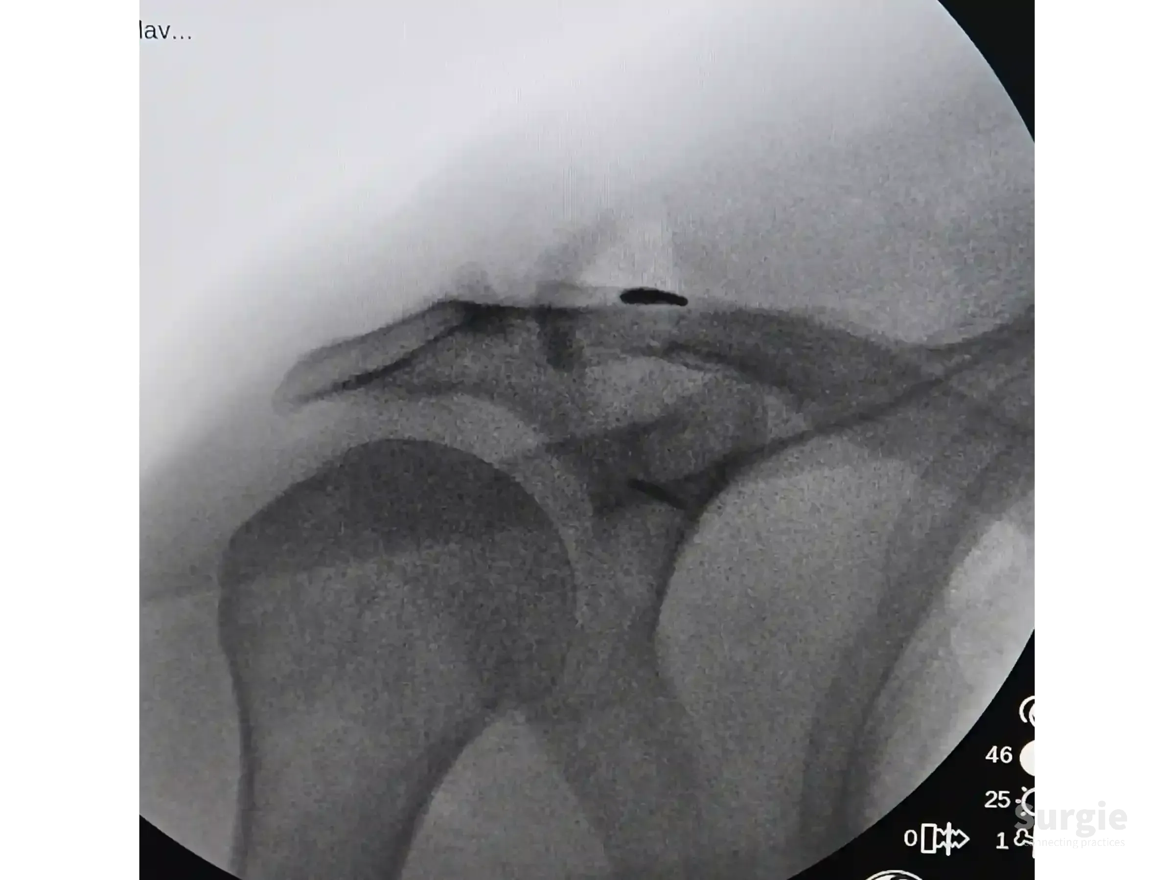 Fluoroscopic X-ray showing TightRope fixation device securing the clavicle to the coracoid process for AC joint repair.
